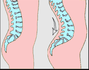 Hyperlordosis of the low back due to overuse of the iliopsoas. 